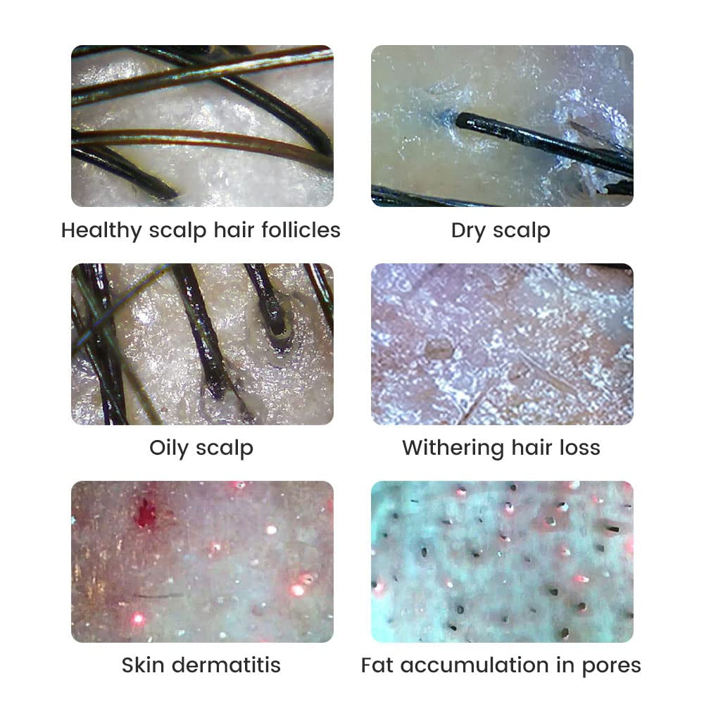 Wireless Skin Analyzer Machine Dermatoscope Scalp/Skin/Hair Follicle Detection Testing Analysis Magnifier UV Skin Analyzer Professional 1000X Facial Skin Detector Digital Microscope
